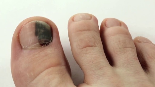 image of nail_disease #24