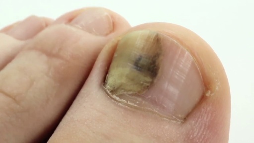 image of nail_disease #25