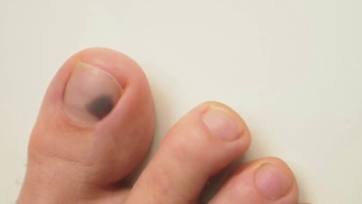 image of nail_disease #26