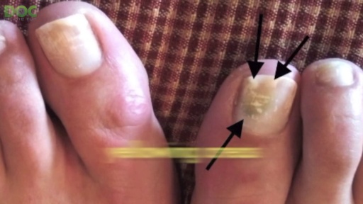 image of nail_disease #27