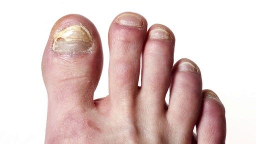 image of nail_disease #28