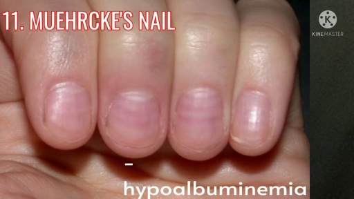 image of nail_disease #6