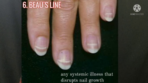 image of nail_disease #7