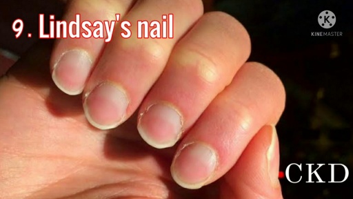 image of nail_disease #8