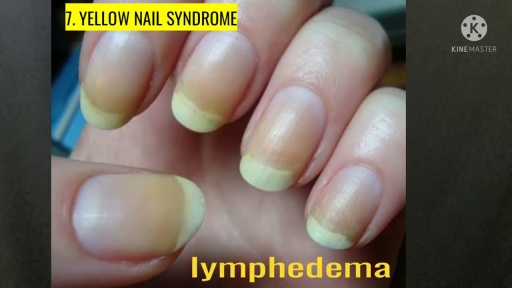 image of nail_disease #9