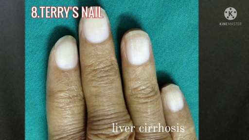 image of nail_disease #10