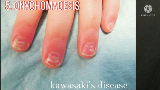 image of nail_disease #11