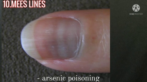 image of nail_disease #13