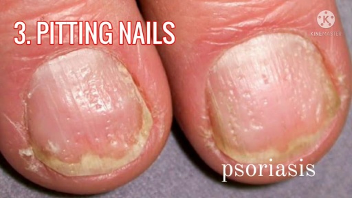 image of nail_disease #14