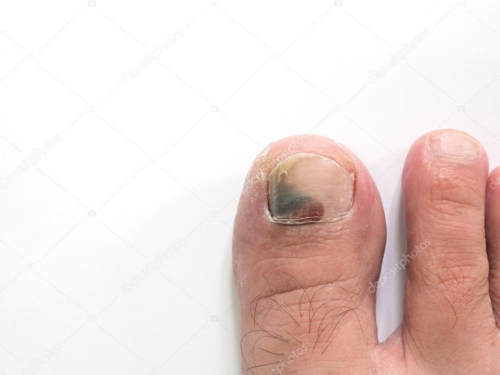 image of nail_disease #2