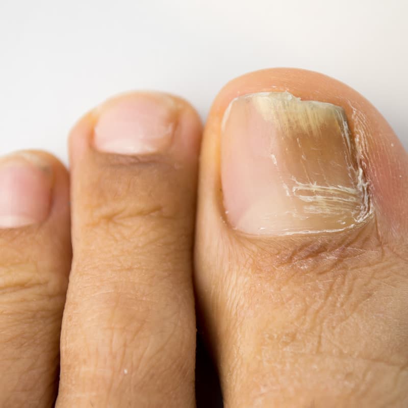 image of nail_disease #3