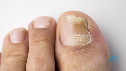 image of nail_disease #17