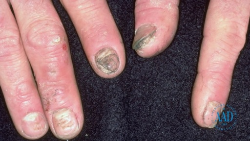 image of nail_disease #18