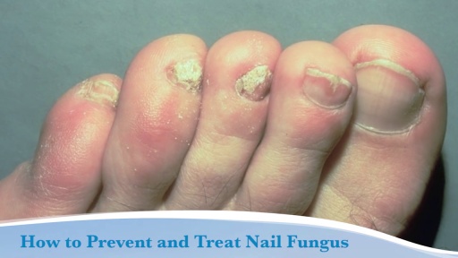 image of nail_disease #19