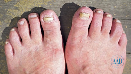 image of nail_disease #20