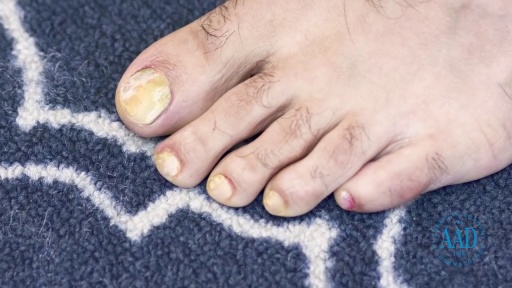 image of nail_disease #21