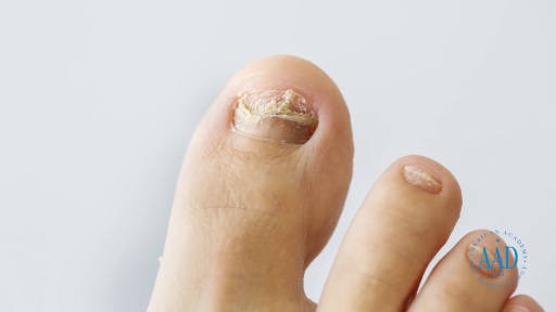 image of nail_disease #22