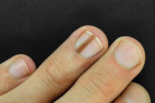 image of nail_disease #0