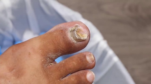 image of nail_disease #29