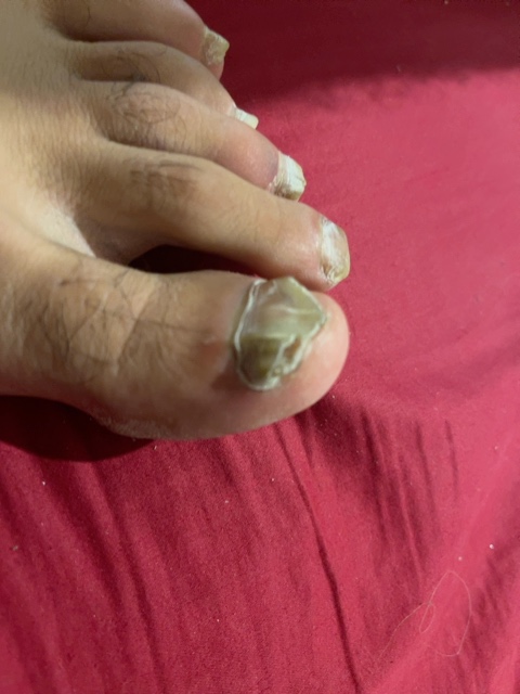 image of nail_disease #4