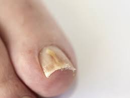 image of nail_disease #1