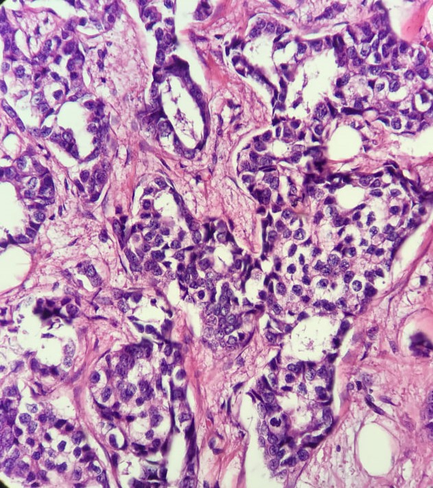 image of idc_breast_cancer_grading #0