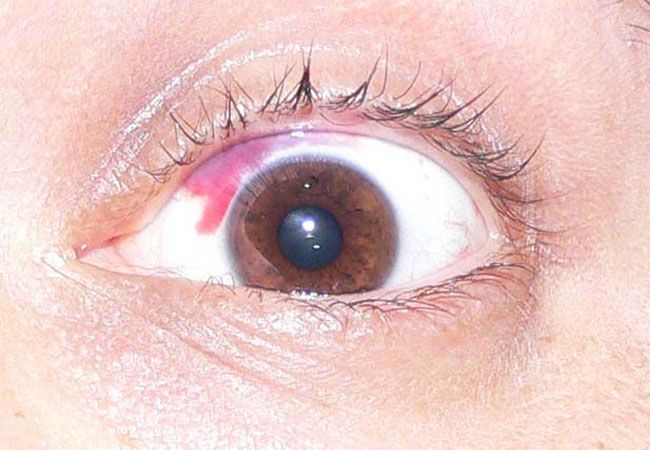 La cirugía LASIK