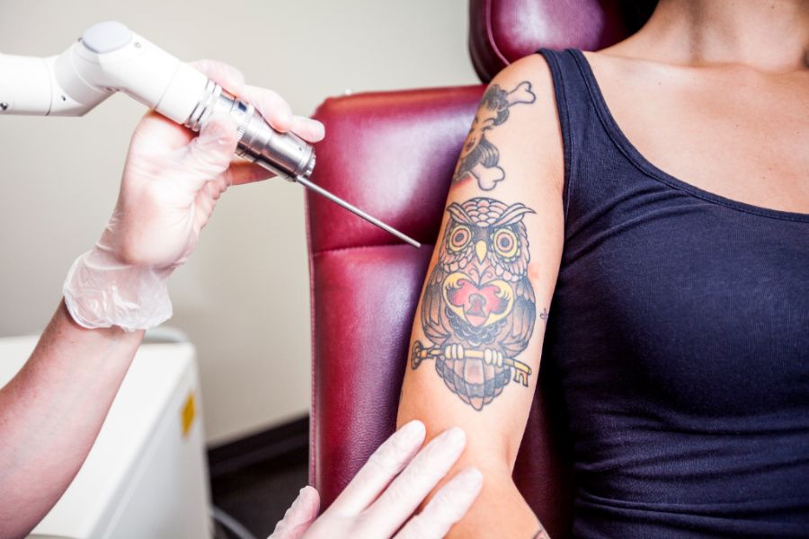 Eliminación de tatuajes en Badajoz: diferentes procedimientos