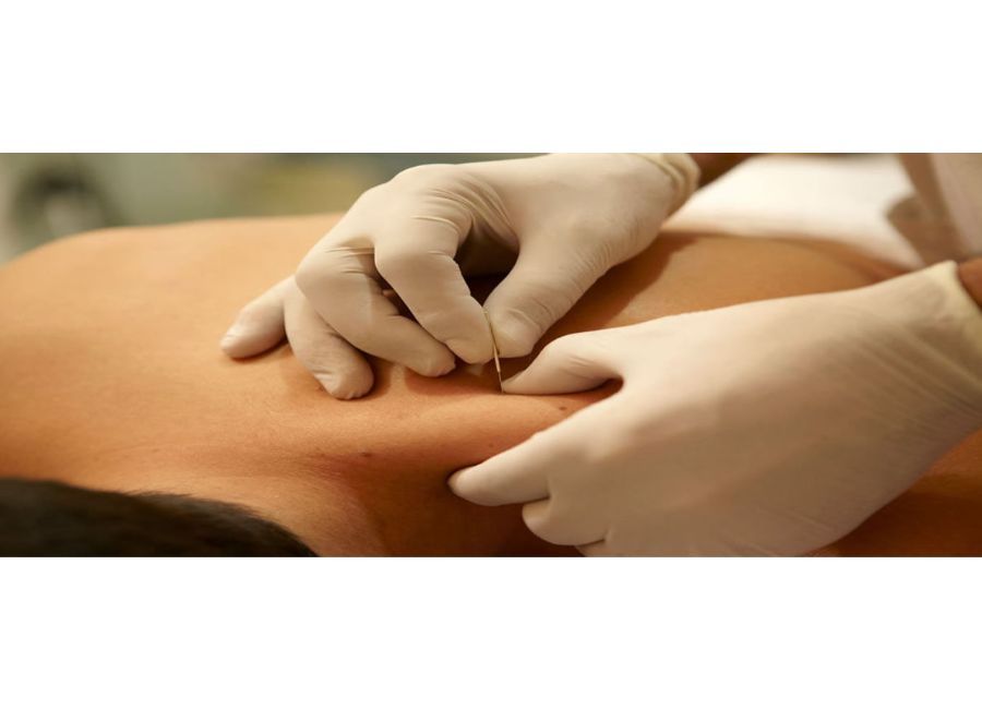 ¿Qué es la punción seca en fisioterapia?