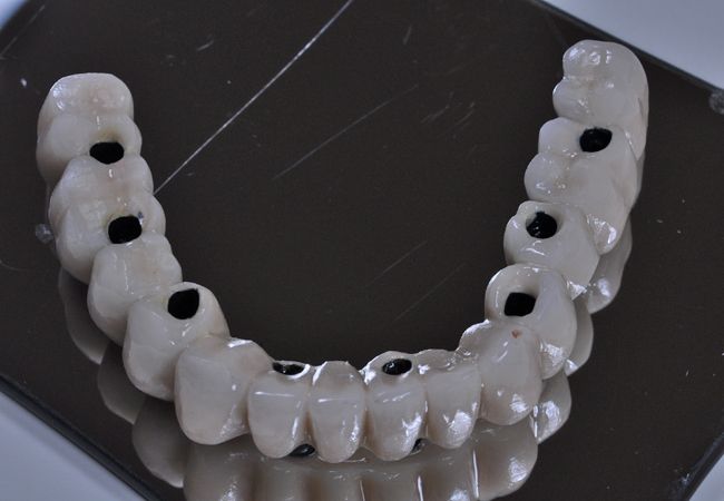 ¿Qué son los implantes dentales y cuáles son sus beneficios?