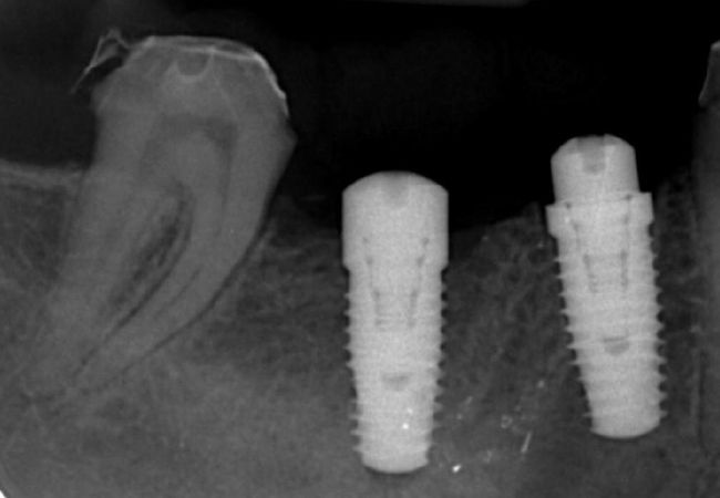 Cómo cuidar los implantes dentales