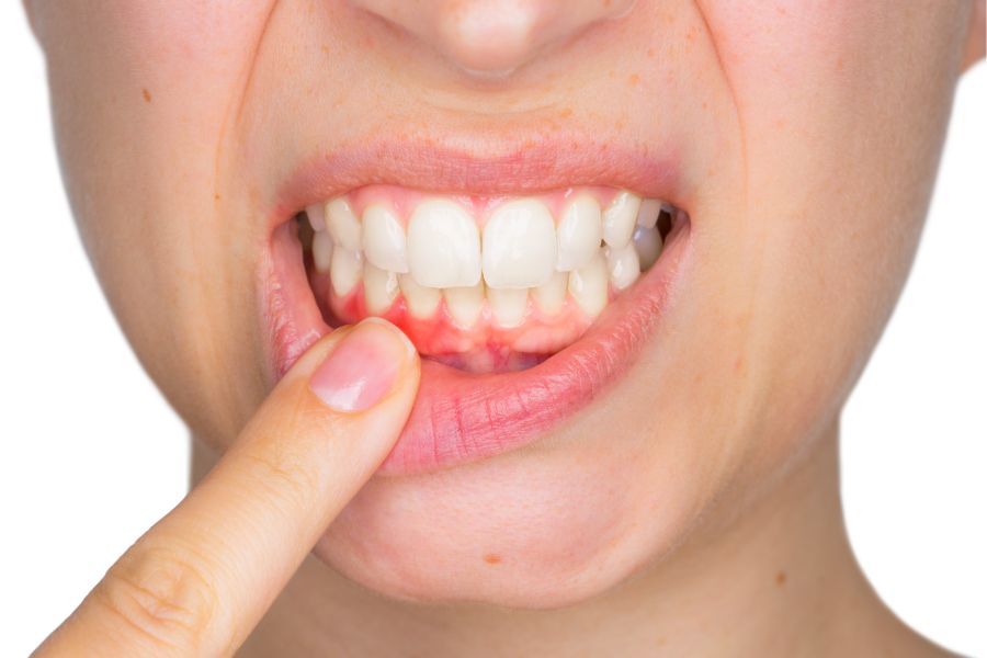 La importancia de tratar a tiempo la gingivitis