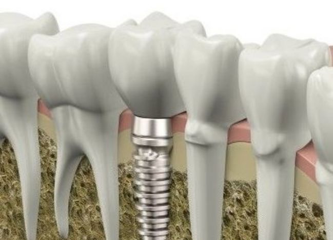 Ventajas de los implantes dentales