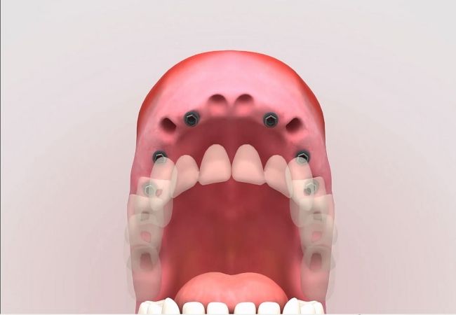 Los tipos de implantes dentales