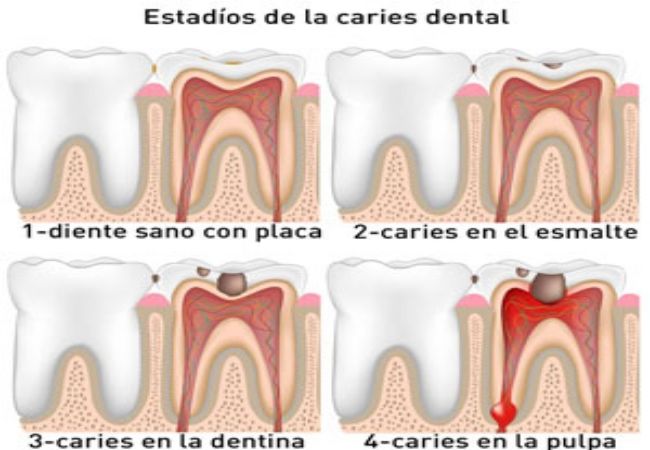 ¿Qué es una endodoncia?