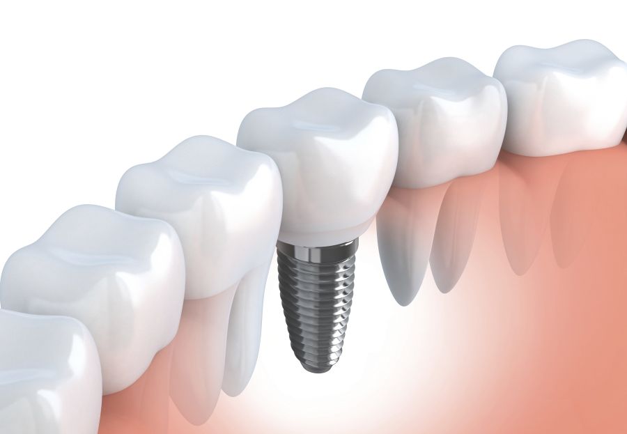 ¿Cómo se sujeta un implante dental?