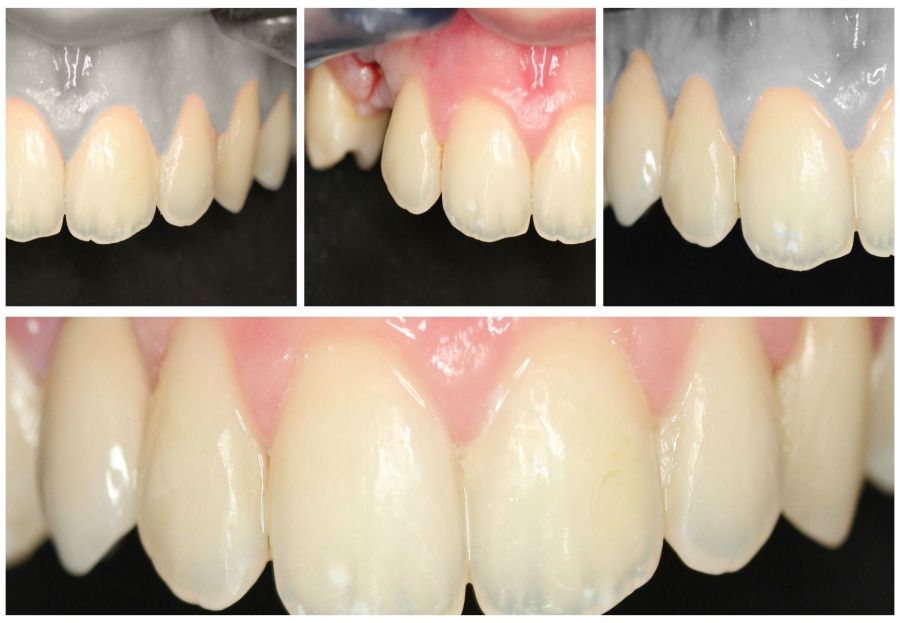 Problemas derivados de la pérdida de una pieza dental