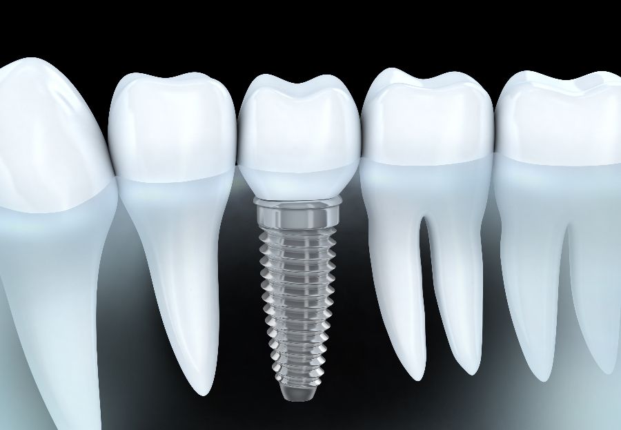 Implantes dentales, ¿qué tipos hay?