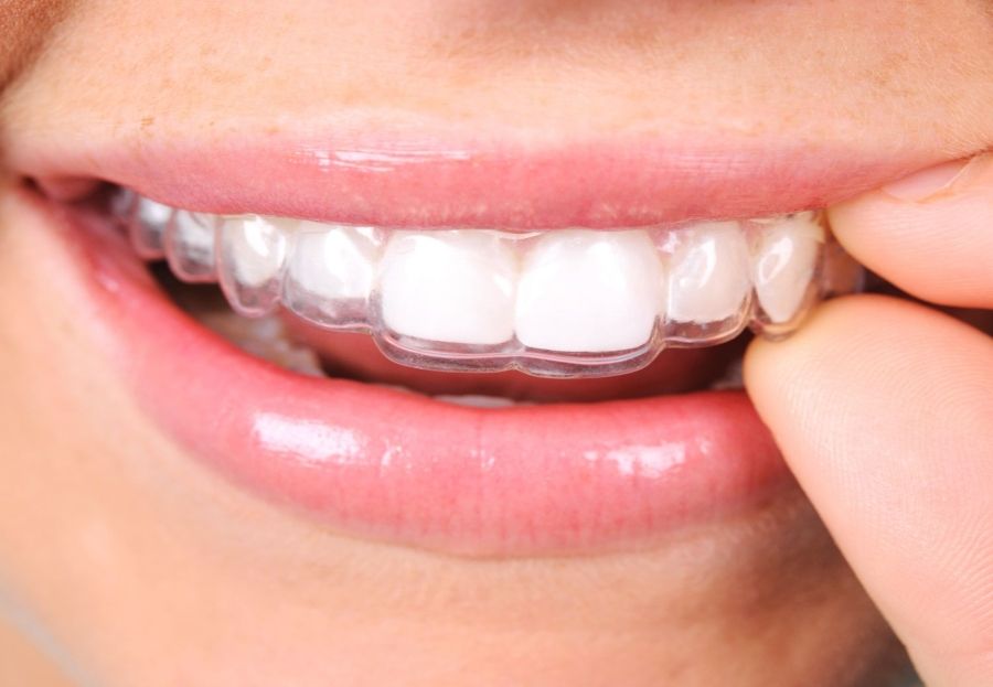 Ventajas del método Invisalign