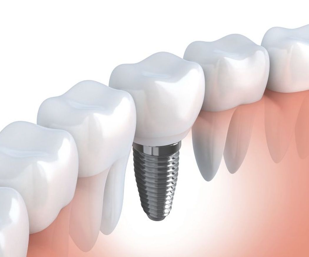 Tipos de implantes dentales