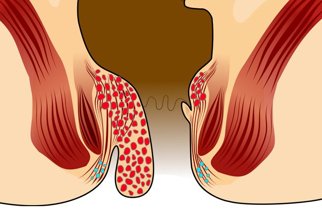 ¿Qué son las hemorroides?