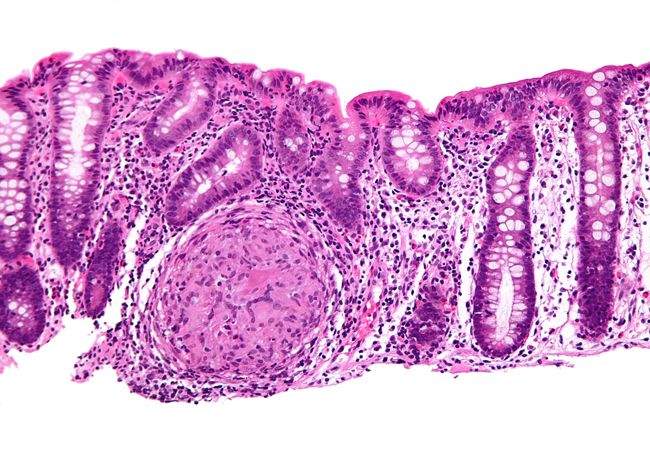 ¿Sabes qué es la enfermedad de Crohn?