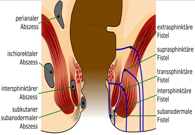 Diferencias entre fístula y fisura