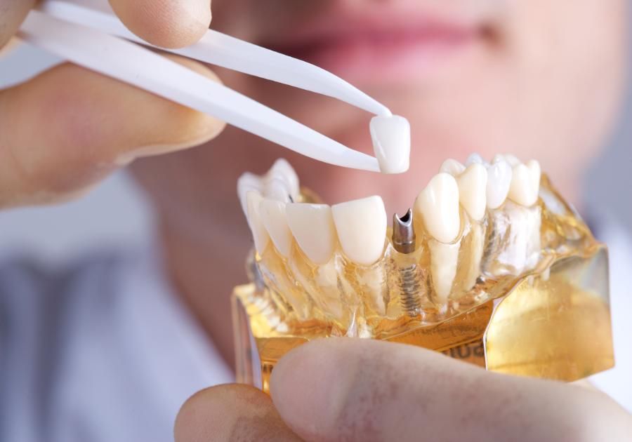 Cómo se fabrican los implantes dentales