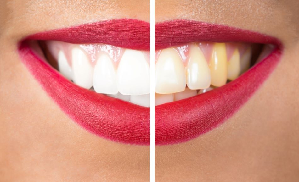 ¿Conoce los beneficios del blanqueamiento dental?