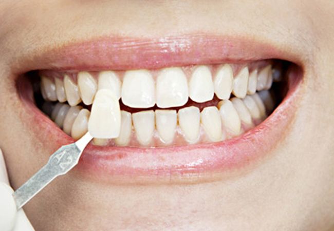 Estética dental al alcance de todos los presupuestos