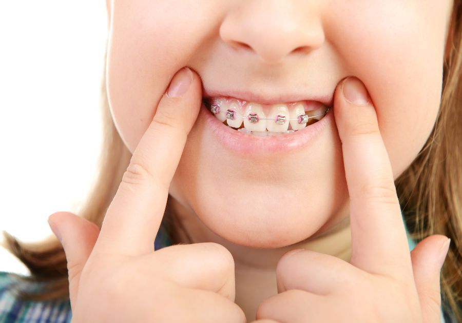 ¿A qué edad es conveniente colocar un aparato dental?