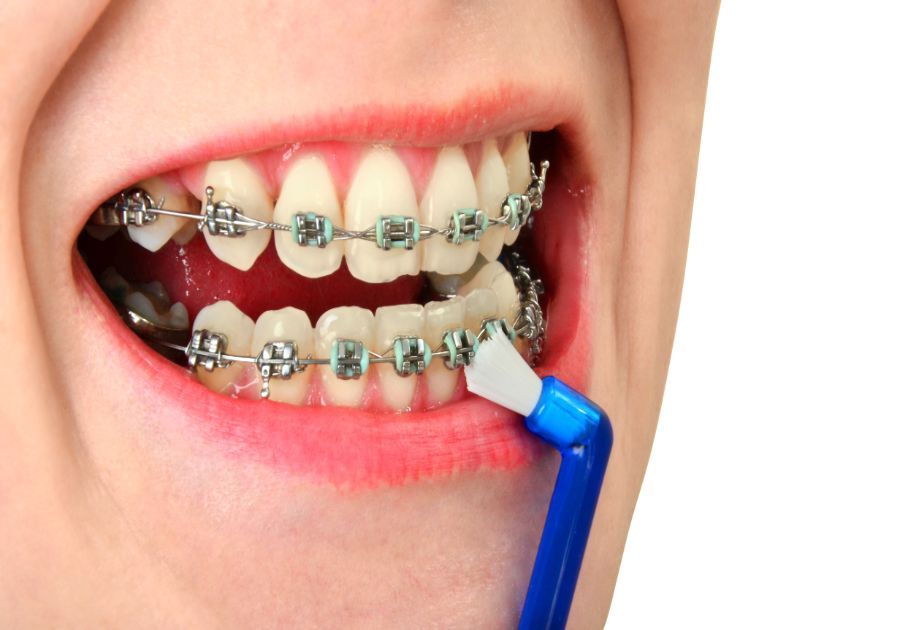 Consejos para limpiarte los dientes con ortodoncia