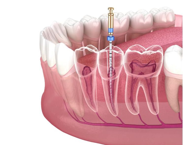 Endodoncia: tipos y algunas precisiones