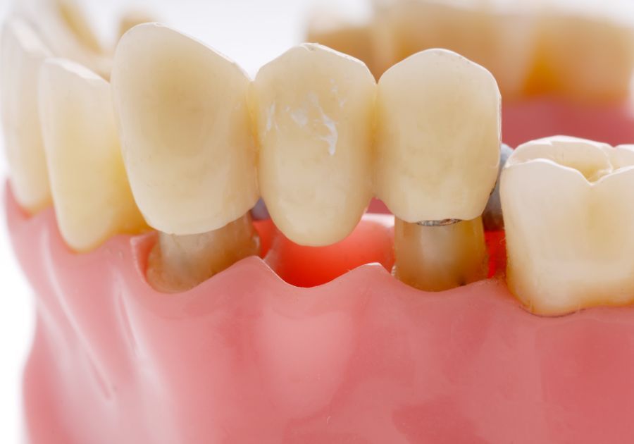 Tipos de implantes dentales